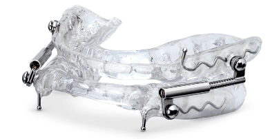 OASYS Oral Nasal Airway System oral appliance
