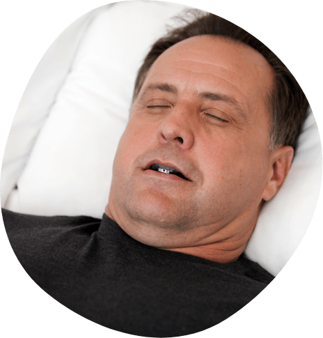 Sleeping man wearing oral appliance for snoring treatment
