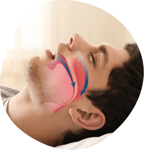 Side profile of sleeping man with airway illustrated